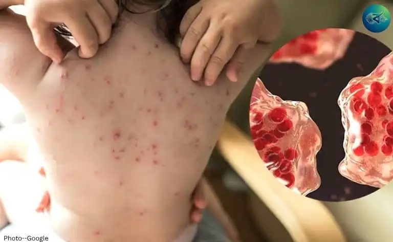 হামের ঝুঁকিতে ৩০ উপজেলা